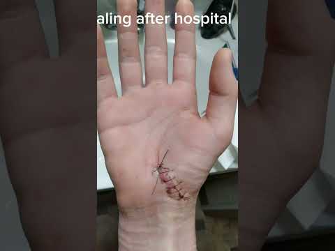 Thumbnail for Stitches are out the 23rd of June! #healing #health #stitches #scar by Cream